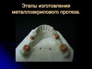 несьёмные протезы