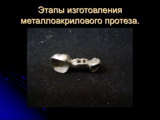 несьёмные протезы