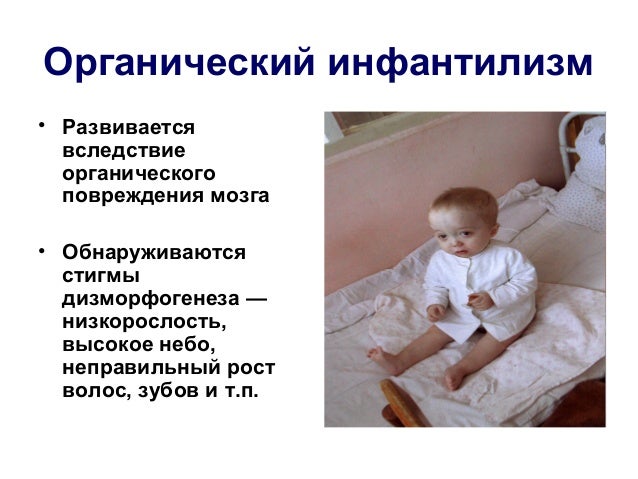 Моторный инфантилизм это
