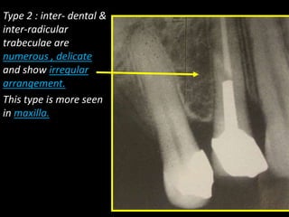 Type 2 : inter- dental &
inter-radicular
trabeculae are
numerous , delicate
and show irregular
arrangement.
This type is more seen
in maxilla.
 