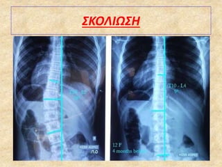 ΣΚΟΛΙΩΣΗ
 