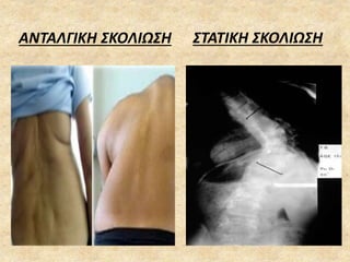 ΑΝΤΑΛΓΙΚΗ ΣΚΟΛΙΩΣΗ ΣΤΑΤΙΚΗ ΣΚΟΛΙΩΣΗ
 