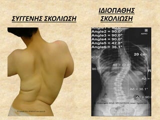 ΣΥΓΓΕΝΗΣ ΣΚΟΛΙΩΣΗ
ΙΔΙΟΠΑΘΗΣ
ΣΚΟΛΙΩΣΗ
 