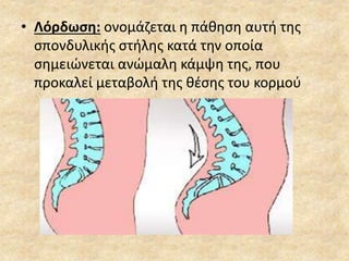 • Λόρδωση: ονομάζεται η πάθηση αυτή της
σπονδυλικής στήλης κατά την οποία
σημειώνεται ανώμαλη κάμψη της, που
προκαλεί μεταβολή της θέσης του κορμού
 