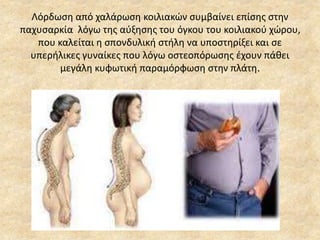 Λόρδωση από χαλάρωση κοιλιακών συμβαίνει επίσης στην
παχυσαρκία λόγω της αύξησης του όγκου του κοιλιακού χώρου,
που καλείται η σπονδυλική στήλη να υποστηρίξει και σε
υπερήλικες γυναίκες που λόγω οστεοπόρωσης έχουν πάθει
μεγάλη κυφωτική παραμόρφωση στην πλάτη.
 