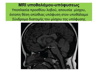 MRI υποθαλάμου-υπόφυσεως
Υποπλασία προσθίου λοβού, απουσία μίσχου,
έκτοπη θέση οπίσθιας υπόφυση στον υποθάλαμο
Σύνδρομο διατομής του μίσχου της υπόφυσης
 