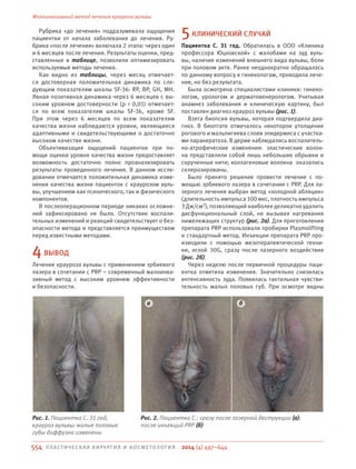 554 П ЛА С Т И ЧЕ СКАЯ ХИРУРГИЯ И КОСМЕТОЛОГИЯ
Малоинвазивный метод лечения крауроза вульвы
2014 (4) 497–644
Рубрика «до лечения» подразумевала ощущения
пациентки от начала заболевания до лечения. Ру-
брика «после лечения» включала 2 этапа: через один
и 6 месяцев после лечения. Результаты оценки, пред-
ставленные в таблице, позволили оптимизировать
используемые методы лечения.
Как видно из таблицы, через месяц отмечает-
ся достоверная положительная динамика по сле-
дующим показателям шкалы SF-36: RP, BP, GH, MH.
Явная позитивная динамика через 6 месяцев с вы-
соким уровнем достоверности (p < 0,01) отмечает-
ся по всем показателям шкалы SF-36, кроме SF.
При этом через 6 месяцев по всем показателям
качества жизни наблюдаются уровни, являющиеся
адаптивными и свидетельствующими о достаточно
высоком качестве жизни.
Объективизация ощущений пациентки при по-
мощи оценки уровня качества жизни предоставляет
возможность достаточно полно проанализировать
результаты проведенного лечения. В данном иссле-
довании отмечается положительная динамика изме-
нения качества жизни пациенток с краурозом вуль-
вы, улучшением как психического, так и физического
компонентов.
В послеоперационном периоде никаких осложне-
ний зафиксировано не было. Отсутствие воспали-
тельных изменений и реакций свидетельствует о без-
опасности метода и представляется преимуществом
перед известными методами.
4ВЫВОД
Лечение крауроза вульвы с применением эрбиевого
лазера в сочетании с PRP – современный малоинва-
зивный метод с высоким уровнем эффективности
и безопасности.
5КЛИНИЧЕСКИЙ СЛУЧАЙ
Пациентка С. 31 год. Обратилась в ООО «Клиника
профессора Юцковской» с жалобами на зуд вуль-
вы, наличие изменений внешнего вида вульвы, боли
при половом акте. Ранее неоднократно обращалась
по данному вопросу к гинекологам, проводила лече-
ние, но без результата.
Была осмотрена специалистами клиники: гинеко-
логом, урологом и дерматовенерологом. Учитывая
анамнез заболевания и клиническую картину, был
поставлен диагноз крауроз вульвы (рис. 1).
Взята биопсия вульвы, которая подтвердила диа-
гноз. В биоптате отмечалось некоторое утолщение
рогового и мальпигиева слоев эпидермиса с участка-
ми паракератоза. В дерме наблюдались воспалитель-
но-атрофические изменения: эластические волок-
на представляли собой лишь небольшие обрывки и
скрученные нити; коллагеновые волокна оказались
склерозированы.
Было принято решение провести лечение с по-
мощью эрбиевого лазера в сочетании с PRP. Для ла-
зерного лечения выбран метод «холодной абляции»
(длительность импульса 100 мкс, плотность импульса
3 Дж/см2), позволяющий наиболее деликатно удалить
дисфункциональный слой, не вызывая нагревания
нижележащих структур (рис. 2а). Для приготовления
препарата PRP использовали пробирки Plasmolifting
и стандартный метод. Инъекции препарата PRP про-
изводили с помощью мезотерапевтической техни-
ки, иглой 30G, сразу после лазерного воздействия
(рис. 2б).
Через неделю после первичной процедуры паци-
ентка отметила изменения. Значительно снизилась
интенсивность зуда. Появилась тактильная чувстви-
тельность малых половых губ. При осмотре видны
Рис. 1. Пациентка С. 31 год,
крауроз вульвы: малые половые
губы диффузно изменены
Рис. 2. Пациентка С.: сразу после лазерной деструкции (а);
после инъекций PRP (б)
а б
 