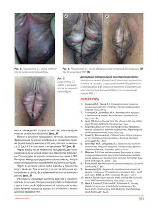 555Лабиопластика
очаги отхождения струпа и участки эпителизации
(чистая слизистая оболочка) (рис. 3).
Принято решение продолжать лечение. Выполнена
фракционная лазерная шлифовка в «холодном» режи-
ме (длительность импульса 100 мкс, плотность импуль-
са 15 Дж/см2) в сочетании с инъекциями PRP (рис. 4).
Через месяц после первичной процедуры достигну-
та полная клиническая ремиссия. Пациентке проведе-
ны 2 процедуры лазерного лечения в сочетании с PRP.
Интервал между процедурами составил месяц. Интра-
и постоперационных осложнений выявлено не было.
Через 6 месяцев какие либо жалобы у пациентки
отсутствовали. При осмотре: слизистая оболочка яр-
ко-розового цвета, без изменений и очагов гиперке-
ратоза (рис. 5).
Результаты процедур оценены врачом и пациент-
кой как отличные. Полученные результаты позволяют
судить о высокой эффективности процедуры лазер-
ного лечения крауроза вульвы в сочетании с инъек-
ционной формой PRP.
Декларация материальной заинтересованности:
авторы не имеют финансовой заинтересованности
и никак не связаны с производителем оборудования
и материалов. Е.В. Лешунов является внештатным
консультантом фирмы Asclepion по применению
лазера MCL 31.
ЛИТЕРАТУРА
1. Баранов И.И., Серов В.Н. Климактоплан в терапии
климактерического синдрома. Русский медицинский
журнал 2005;1:11–14.
2. Паллади Г.А., Штемберг М.И., Яковлева И.А. Крауроз
и лейкоплакия вульвы. Акушерство и гинекология
1977;2:61–64.
3. Levis FM. Vulva disease from the 1800s to the new millen-
nium. J Cutan Med Surg 2002;6(4):340–344.
4. Башкирова А.А. Лечение дистрофических процессов
вульвы у девочек и девочек-подростков. Здравоохране-
ние Башкортостана 2000;2:131–133.
5. Powell JJ, Wojnarowska F. Chilhood vulvar lichen sclerosus:
an increasingly common problem. J Am Acad Dermatol
2001;44(5):803–806.
6. Штемберг М.И., Шендерева Т.С. Комплексная патоге-
нетическая терапия крауроза и лейкоплакии вульвы.
Здравоохранение, Кишинев, 1980;4:10–12.
7. Маркина Е.И. Роль инфекционных факторов и гормо-
нальных нарушений в генезе дистрофических заболе-
ваний вульвы и их комплексное лечение. Автореф. дисс.
канд. мед.наук. М., 2003. – 24с.
8. Бохман Я.В. Руководство по онкогинекологии. Л.: Меди-
цина, 1989. С. 464
9. Бронештер Д.Ш. Лечение дистрофических процессов
вульвы с помощью ИК-лазерного излучения. Дисс. канд.
мед. наук. ММА им. И.М. Сеченова. М, 1991 – 106 с.
10. Marx R. Platelet-reach plasma (PRP): what is PRP and what
is not PRP? Implant dentistry 2001;10(4):121–125.
11. Marx R, Carlson T, Eichstaedt R, Schimmele S, Struss J.
Platelet-rich plasma: growth factor enhancement for
bone grafts. Oral Surgery, Oral Medicine, Oral Pathology
1998;85(6):6438–6446.
Рис. 3. Пациентка С.: через неделю
после первичной процедуры
Рис. 5.
Пациентка С.:
через 6 месяцев
после первичной
процедуры
Рис. 4. Пациентка С.: после фракционной лазерной деструкции (а);
после инъекций PRP (б)
а б
 