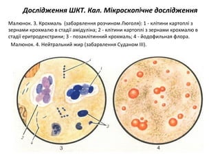Дослідження ШКТ. Кал. Мікроскопічне дослідження
Малюнок. 3. Крохмаль (забарвлення розчином Люголя): 1 - клітини картоплі з
зернами крохмалю в стадії амідуліна; 2 - клітини картоплі з зернами крохмалю в
стадії еритродекстрини; 3 - позаклітинний крохмаль; 4 - йодофильная флора.
Малюнок. 4. Нейтральний жир (забарвлення Суданом III).
 
