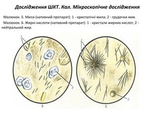 Дослідження ШКТ. Кал. Мікроскопічне дослідження
Малюнок. 5. Мила (нативний препарат): 1 - кристалічні мила; 2 - грудочки мив.
Малюнок. 6. Жирні кислоти (нативний препарат): 1 - кристали жирних кислот; 2 -
нейтральний жир.
 