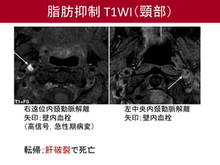 右遠位内頚動脈解離
矢印；壁内血栓
（高信号，急性期病変）
左中央内頚動脈解離
矢印；壁内血栓
脂肪抑制 T1WI（頸部）
転帰；肝破裂で死亡
 