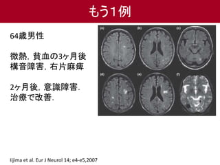 64歳男性
微熱，貧血の3ヶ月後
構音障害，右片麻痺
2ヶ月後，意識障害．
治療で改善．
Iijima et al. Eur J Neurol 14; e4-e5,2007
もう１例
 