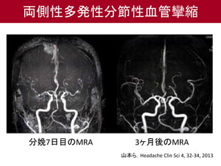 両側性多発性分節性血管攣縮
分娩7日目のMRA 3ヶ月後のMRA
山本ら．Headache Clin Sci 4, 32-34, 2013
 