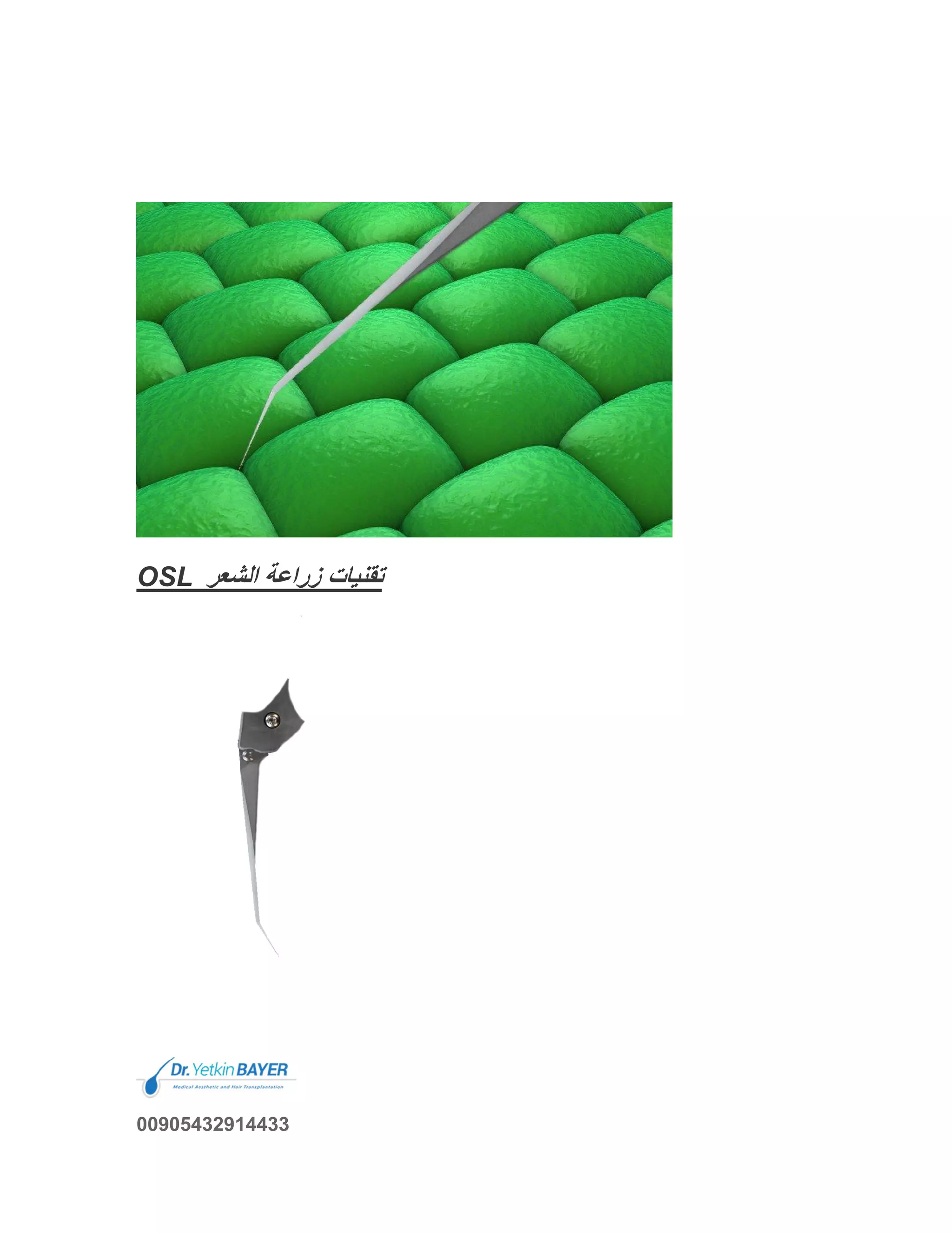 OSL ‫اﻟﺷﻌر‬ ‫زراﻋﺔ‬ ‫ﺗﻘﻧﯾﺎت‬
00905432914433
 