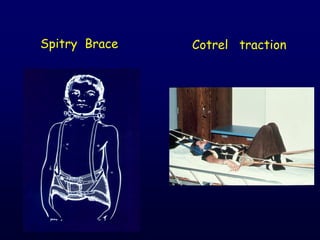Spitry Brace Cotrel traction
 