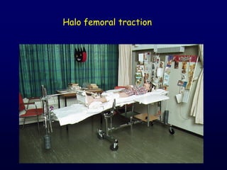 Halo femoral traction
 