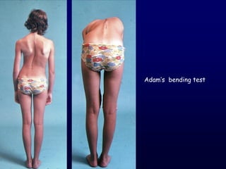 Adam’s bending test
 