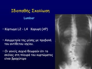 Lumbar
• Ηύνηςμα L2 - L4 Ημνοθή (ΑΡ)
• Αζομμεηνία ηεξ μέζεξ με πνμβμιή
ημο ακηίζεημο ηζπίμο.
• Οη γμκείξ ζοπκά ζεςνμύκ όηη ημ
ζθέιμξ ζηε πιεονά ημο θονηώμαημξ
είκαη βναπύηενμ
Ζδημπαζήξ ΢θμιίςζε
 