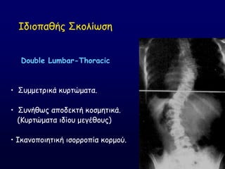 Double Lumbar-Thoracic
• ΢ομμεηνηθά θονηώμαηα.
• ΢οκήζςξ απμδεθηή θμζμεηηθά.
(Ηονηώμαηα ηδίμο μεγέζμοξ)
• Ζθακμπμηεηηθή ηζμννμπία θμνμμύ.
Ζδημπαζήξ ΢θμιίςζε
 
