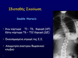 Double thoracic
• Άκς θύνηςμα T1 - T6, Ημνοθή (ΑΡ)
Ηάης θύνηςμα Σ6 – Σ12 Ημνοθή (ΔΓ)
• Γθζεζεμαζμέκε ζηνμθή ηεξ ΢.΢.
• Αζομμεηνία ακώηενμο ζςναθηθμύ
θιςβμύ
.
Ζδημπαζήξ ΢θμιίςζε
 