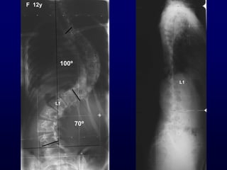 L1
70º
100º
L1
F 12y
 