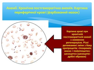 Анемії. Хронічна постгеморагічна анемія. Картина
периферічної крові (фарбований мазок)
Картина крові при
хронічній
постгеморагічній анемії
з зниженою
регенерацією. Різкі
дегенеаивні зміни з боку
єритроцитів: гіпохромія;
анизо- і пойкілоцитоз;
шизоцитоз (шизоцити-
дрібні обривки)
 