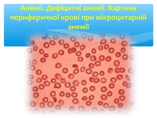 Анемії. Дефіцитні анемії. Картина
периферичної крові при мікроцитарній
анемії
 