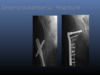 Intertrochanteric fracture
 