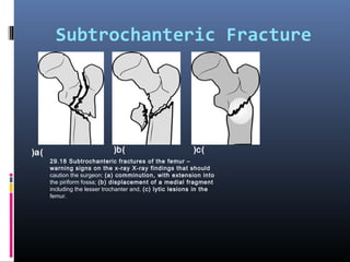 Subtrochanteric Fracture
29.18 Subtrochanteric fractures of the femur –
warning signs on the x-ray X-ray findings that should
caution the surgeon: (a) comminution, with extension into
the piriform fossa; (b) displacement of a medial fragment
including the lesser trochanter and, (c) lytic lesions in the
femur.
)a( )b( )c(
 