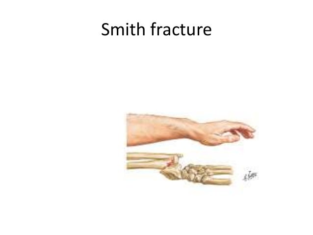 colles fracture vs smith fracture x ray