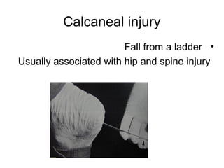 Calcaneal injury
•Fall from a ladder
Usually associated with hip and spine injury
 