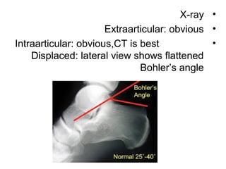 •X-ray
•Extraarticular: obvious
•Intraarticular: obvious,CT is best
Displaced: lateral view shows flattened
Bohler’s angle
 