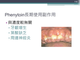 Phenytoin長期使用副作用
• 與濃度較無關
▫ 牙齦增生
▫ 葉酸缺乏
▫ 周邊神經炎
118
 