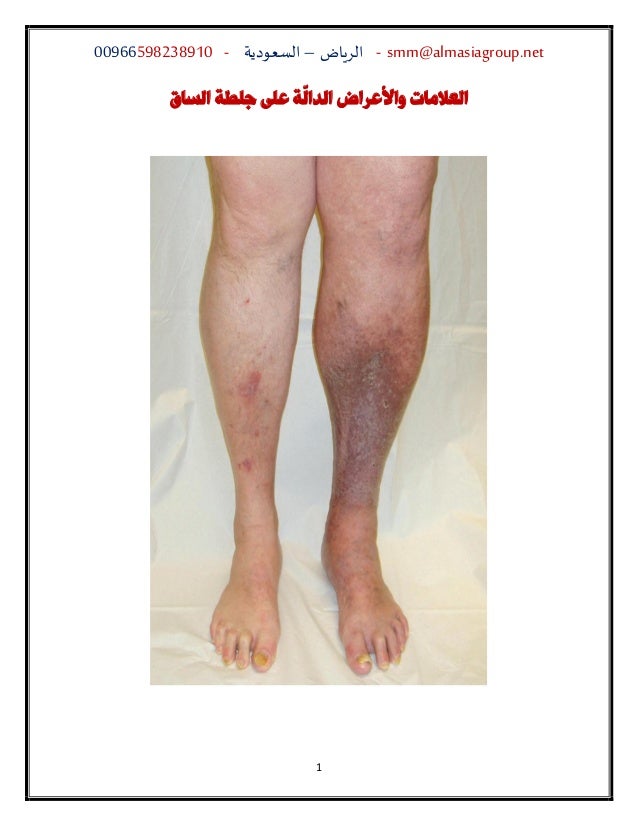 العلامات والأعراض الدال ة على جلطة الساق