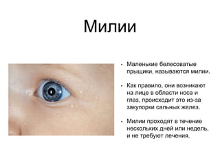 Милии
• Маленькие белесоватые
прыщики, называются милии.
• Как правило, они возникают
на лице в области носа и
глаз, происходит это из-за
закупорки сальных желез.
• Милии проходят в течение
нескольких дней или недель,
и не требуют лечения.
 