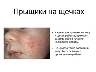 Прыщики на щечках
• Чаще всего прыщики на носу
и щеках ребенка, проходят
сами по себе в течение
нескольких недель.
• Но, иногда такие состояния
могут быть связаны с
дрожжевыми грибами.
 