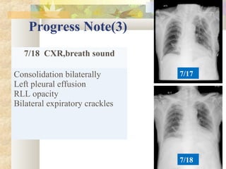 Progress Note(3)
7/18 CXR,breath sound
Consolidation bilaterally
Left pleural effusion
RLL opacity
Bilateral expiratory crackles
7/17
7/18
 