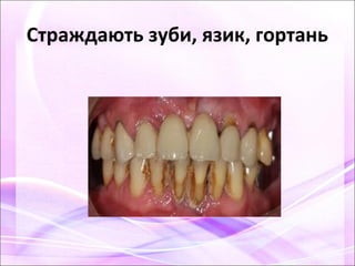 Страждають зуби, язик, гортань
 