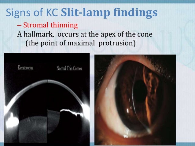 Keratoconus