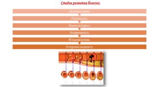 Атерокальциноз.
Изъязвление.
Атероматоз.
Липосклероз.
Липоидоз.
Долипидная.
Стадии развития болезни:
 