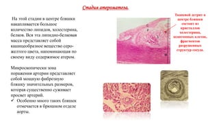 Стадия атероматоза.
На этой стадии в центре бляшки
накапливается большое
количество липидов, холестерина,
белков. Вся эта липидно-белковая
масса представляет собой
кашицеобразное вещество серо-
желтого цвета, напоминающая по
своему виду содержимое атером.
Микроскопически зона
поражения артерии представляет
собой мощную фиброзную
бляшку значительных размеров,
которая существенно суживает
просвет артерий.
 Особенно много таких бляшек
отмечается в брюшном отделе
аорты.
Тканевой детрит в
центре бляшки
состоит из
кристаллов
холестерина,
ксантомных клеток,
фрагментов
разрушенных
структур сосуда.
 