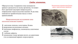 Образуется язва. Содержимое язвы вымывается
кровью и разносится по всему организму, что может
быть причиной закупорки микрососудов и
повреждению ткани вследствие ишемии. В дне язвы
появляются тромботические массы и очаги
кровоизлияний.
Микроскопические исследования зоны
патологии позволяют выявить:
 скопления липидов, холестерина, белков.
 разрушение коллагеновых волокон.
 скопления лимфоцитов, плазмоцитов, ксантомных
клеток
 глубокие дефекты.
 изъязвление стенки артерии вплоть до адвентиции
(это осложненный вариант атеросклероза).
Стадия изъязвления.
Изъязвленная атероматозная бляшка
аорты с пристеночным тромбозом.
 