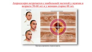 Атеросклероз встречается с наибольшей частотой у мужчин в
возрасте 50-60 лет и у женщин старше 60 лет.
Прогрессирование атеросклероза.
 