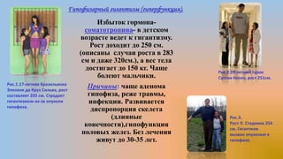 Гипофизарный гигантизм (гиперфункция).
Избыток гормона-
соматотропина- в детском
возрасте ведет к гигантизму.
Рост доходит до 250 см.
(описаны случаи роста в 283
см и даже 320см.), а вес тела
достигает до 150 кг. Чаще
болеют мальчики.
Причины: чаще аденома
гипофиза, реже травмы,
инфекции. Развивается
диспропорция скелета
(длинные
конечности),гипофункция
половых желез. Без лечения
живут до 30-35 лет.
Рис.1.17-летняя бразильянка
Элизани да Круз Сильва, рост
составляет 203 см. Страдает
гигантизмом из-за опухоли
гипофиза.
Рис.2.29-летний турок
Султан Косен, рост 251см.
Рис.3.
Рост Л. Стадника 254
см. Гигантизм
вызван опухолью в
гипофизе.
 