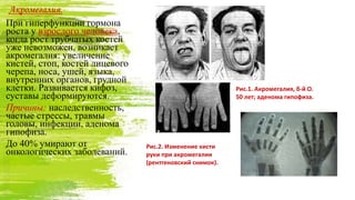 Акромегалия.
При гиперфункции гормона
роста у взрослого человека,
когда рост трубчатых костей
уже невозможен, возникает
акромегалия: увеличение
кистей, стоп, костей лицевого
черепа, носа, ушей, языка,
внутренних органов, грудной
клетки. Развивается кифоз,
суставы деформируются.
Причины: наследственность,
частые стрессы, травмы
головы, инфекции, аденома
гипофиза.
До 40% умирают от
онкологических заболеваний.
Рис.1. Акромегалия, б-й О.
50 лет; аденома гипофиза.
Рис.2. Изменение кисти
руки при акромегалии
(рентгеновский снимок).
 