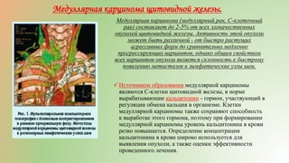 Медуллярная карцинома (медуллярный рак, С-клеточный
рак) составляет до 2-5% от всех злокачественных
опухолей щитовидной железы. Активность этой опухоли
может быть различной - от быстро растущих
агрессивных форм до сравнительно медленно
прогрессирующих вариантов, однако общим свойством
всех вариантов опухоли является склонность к быстрому
появлению метастазов в лимфатические узлы шеи.
Источником образования медуллярной карциномы
являются С-клетки щитовидной железы, в норме
вырабатывающие кальцитонин - гормон, участвующий в
регуляции обмена кальция в организме. Клетки
медуллярной карциномы также сохраняют способность
к выработке этого гормона, поэтому при формировании
медуллярной карциномы уровень кальцитонина в крови
резко повышается. Определение концентрации
кальцитонина в крови широко используется для
выявления опухоли, а также оценки эффективности
проведенного лечения.
Медуллярная карцинома щитовидной железы.
 