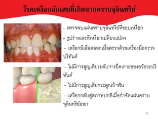 โรคเหงือกอักเสบที่เกิดจากคราบจุลินทรีย์
- ตรเจพหแผยนคราหจุลินทรีบ์ที่ขอหเางือก
- รูปรยางและสีเางือกเปลี่บนแปลง
- เางือกมีเลือดออกเมื่อตรเจด้เบเครื่องมือตรเจ
ปริทันต์
- ไมยมีการสูญเสีบระดัหการบึดเกาะของอเับเะปริ
ทันต์
- ไมยมีการสูญเสีบกระดูกเห้าฟัน
- เางือกกลัหสูยสภาพปกติเมื่อกาจัดแผยนคราห
จุลินทรีบ์ออก
23
 