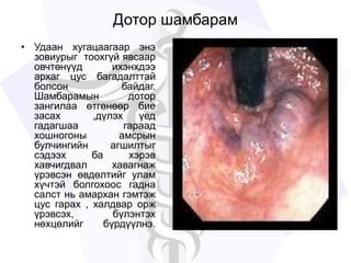Дотор шамбарам
• Удаан хугацаагаар энэ
зовиурыг тоохгүй явсаар
овчтөнүүд ихэнхдээ
архаг цус багадалттай
болсон байдаг.
Шамбарамын дотор
зангилаа өтгөнөөр бие
засах ,дүлэх үед
гадагшаа гараад
хошногоны амсрын
булчингийн агшилтыг
сэдээх ба хэрэв
хавчигдвал хавагнаж
үрэвсэн өвдөлтийг улам
хүчтэй болгохоос гадна
салст нь амархан гэмтэж
цус гарах , халдвар орж
үрэвсэх, бүлэнтэх
нөхцөлийг бүрдүүлнэ.
 