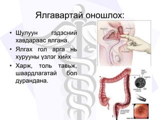 Ялгавартай оношлох:
• Шулуун гэдэсний
хавдараас ялгана.
• Ялгах гол арга нь
хурууны үзлэг хийх
• Харж, толь тавьж,
шаардлагатай бол
дурандана.
 
