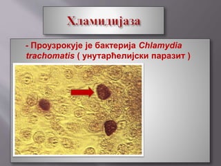 - Проузрокује је бактерија Chlamydia
trachomatis ( унутарћелијски паразит )
 